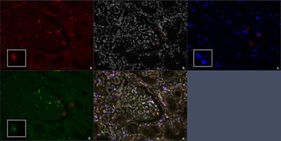 Immune Cell Infiltrate in Chronic-Active Antibody-Mediated Rejection